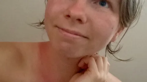 Sonnenbrand